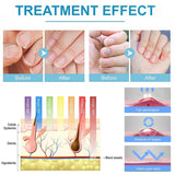 Nail Fungus Treatment Set - Dual Laser Device with Herbal Extracts Serum