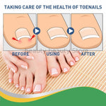 Ingrown Toenail Correction / Pain Relieve Stickers (50 pcs)