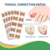 Ingrown Toenail Correction / Pain Relieve Stickers (50 pcs)