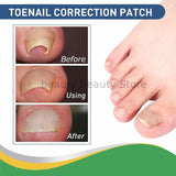 Ingrown Toenail Correction / Pain Relieve Stickers (50 pcs)