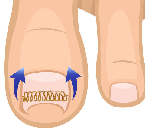Ingrown Toe Nail Correction Wire (12pcs)